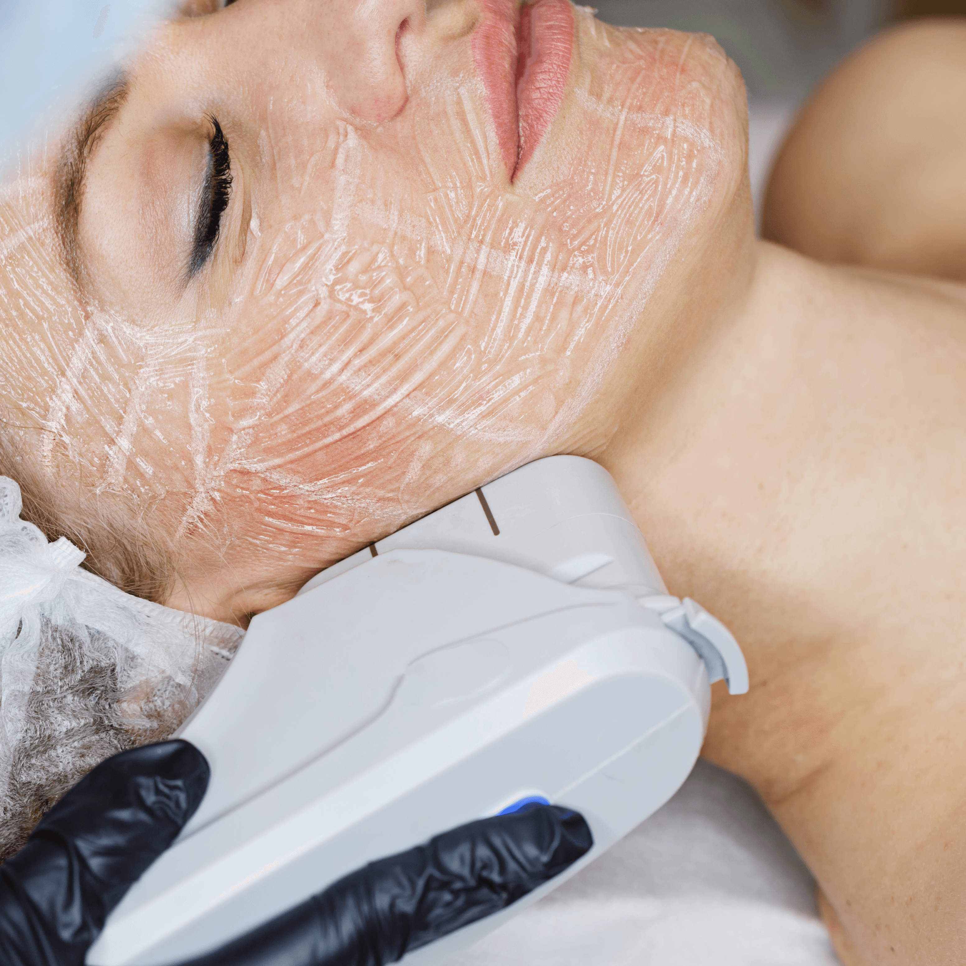 HIFU: The Non-Surgical Facelift Treatment