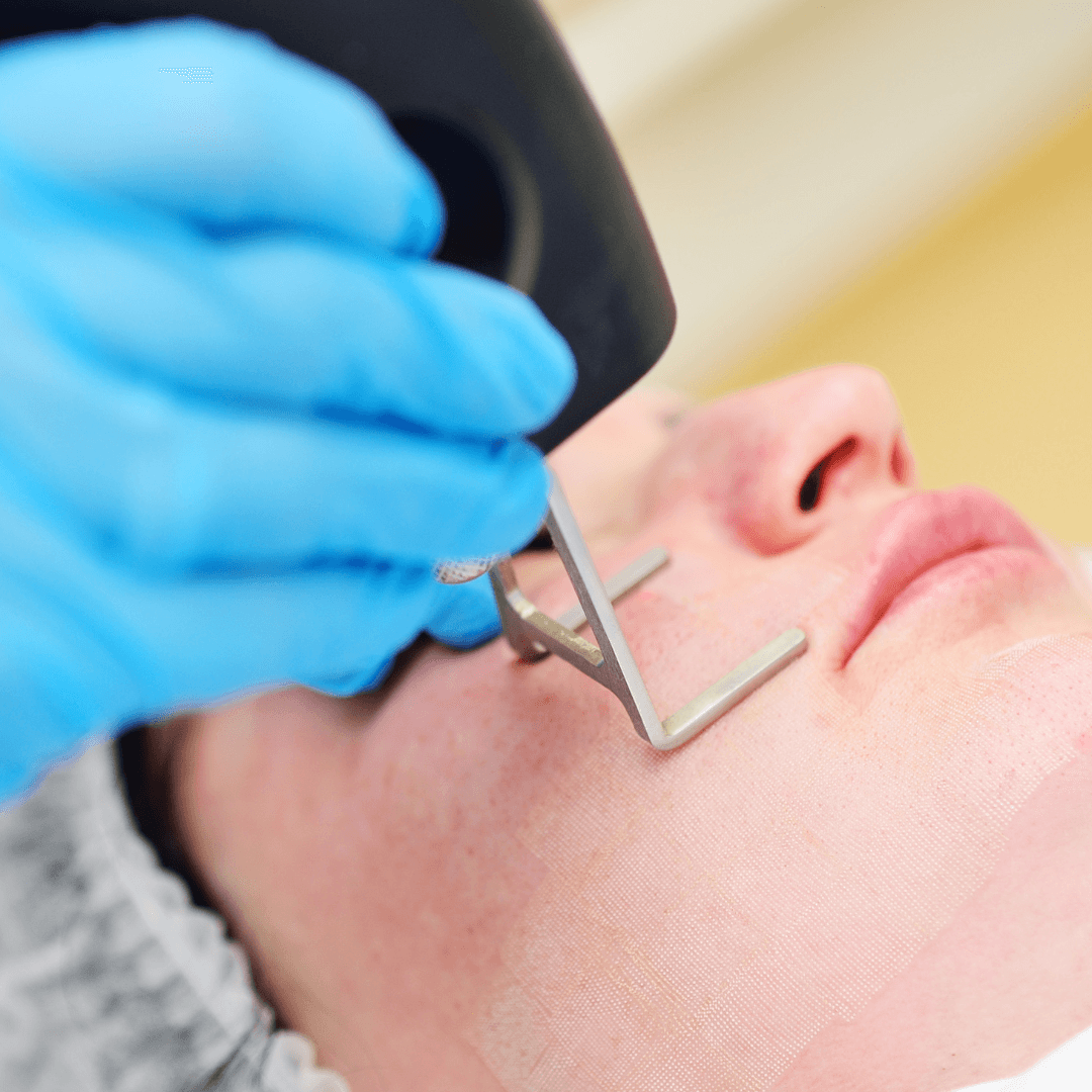 Fractional CO2 Laser: Advanced Skin Resurfacing and Repair